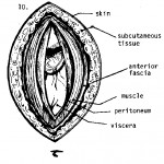Peritoneum is incised and the abdomen is open