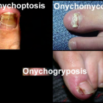 Figure 1-4. Common nail complications