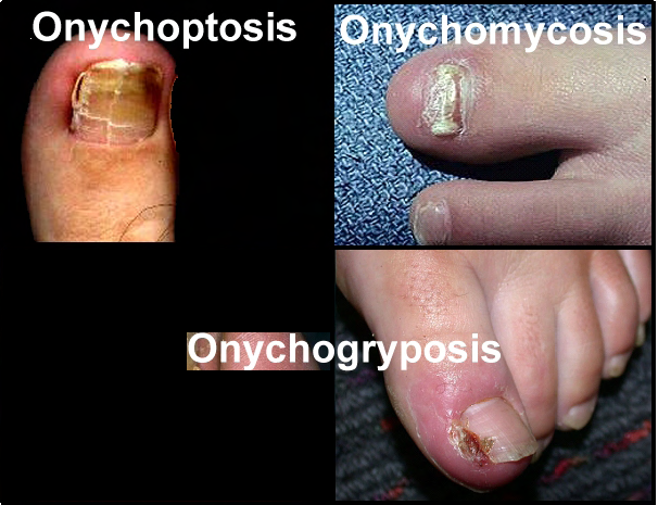 1-05. TOENAIL REMOVAL | Surgical Methods