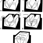 Figure 2-11. The vertical mattress suture