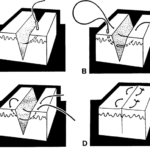 Figure 2-12. The horizontal running suture.