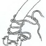 Figure 3-7. Pursestring suture and sandal tie.