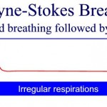 Cheyne Stokes Breathing