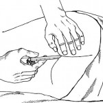 Figure 2-12. Inserting a rectal thermometer in an adult patient.