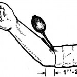 Figure 5-6. Placement of bladder on upper arm.