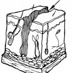 Figure 1-2. Laceration.