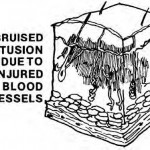 Figure 1-4. Contusion.