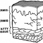 Figure 3-1. First-degree burn.