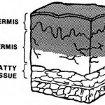Figure 3-2. Second-degree burn.