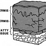 Figure 3-3. Third-degree burn.