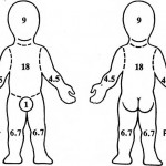 Figure 3-5. Rule of nines for small child body surface burns.